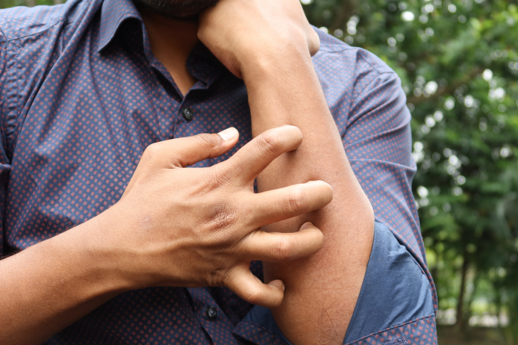 How to Treat Eczema